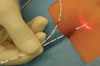 Silac (Sinus Laser Closure) 